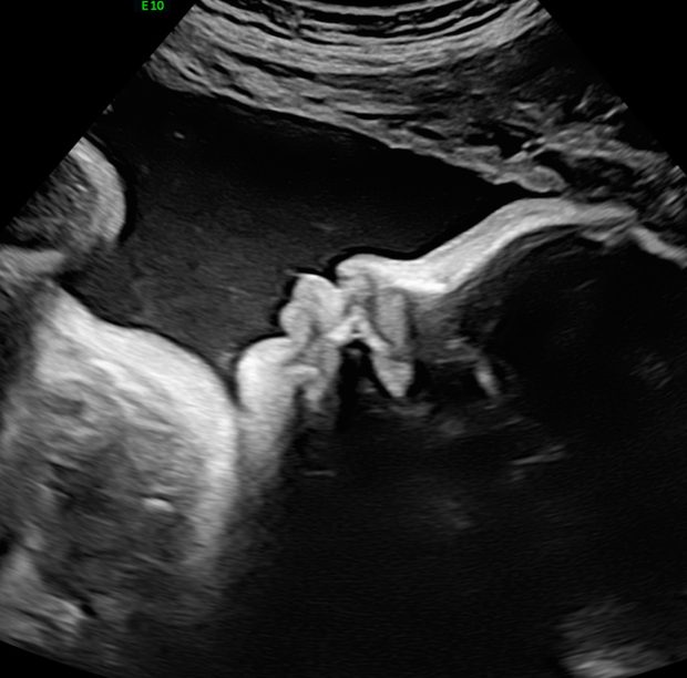 A baby's hands and face in profile on a 2D scan.
