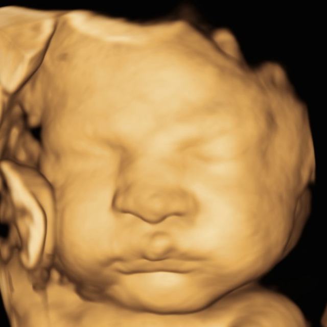 A 3D ultrasound image of a baby's face straight from the scan.