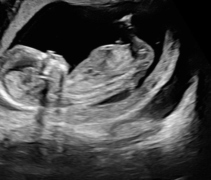 A baby at 13 weeks, curled with a clear profile.