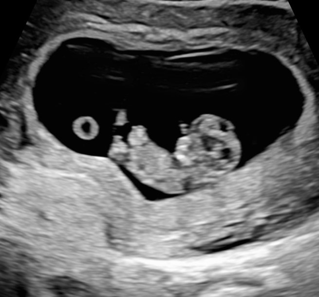 A baby at 10 weeks on 2D ultrasound.