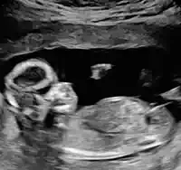 A baby moving at 14 weeks on a 2D ultrasound clip.