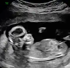 A baby wriggling on a 2D ultrasound clip.
