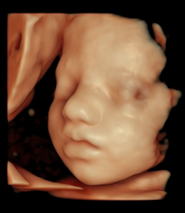 A baby at 31 weeks in HD Live.