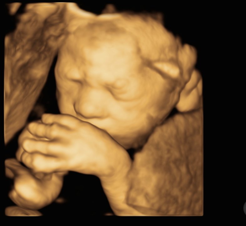 A baby at 27 weeks with hands beside the face.